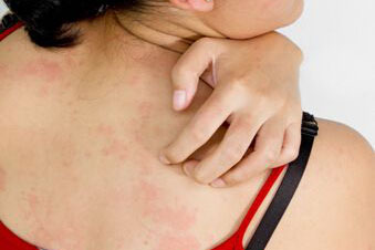 过敏怎么办（简单、快速处理皮肤过敏的方法）