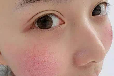 红血丝怎么形成的？（消除红血丝的日常方法和小妙招）
