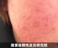 你知道你为什么长玫瑰痤疮吗