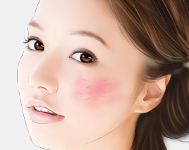 红血丝是怎么形成的