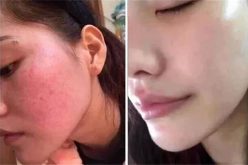 脸上红血丝怎么办？（教你3个日常去红血丝的方法）