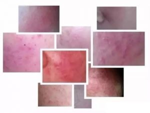 激素依赖性痤疮