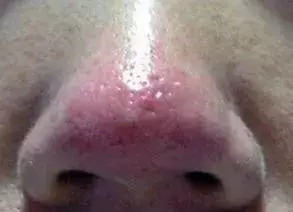 玫瑰痤疮