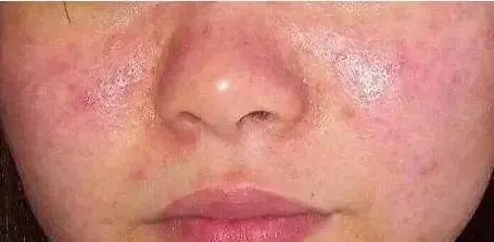 敏感肌有哪些必须知道的知识？源自护肤科普